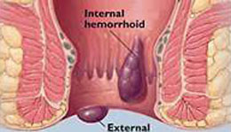 Ano-Rectal Care treatment in kollam